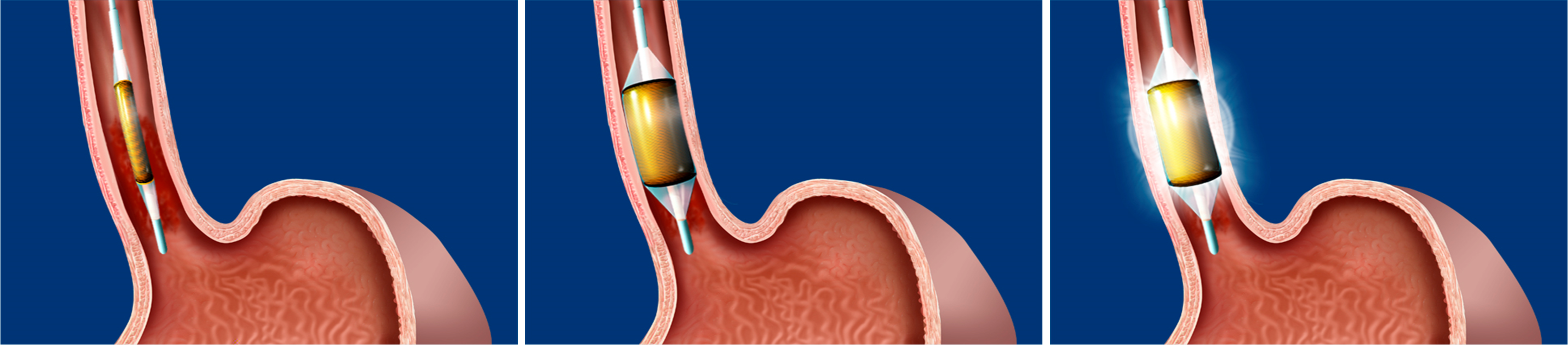 Halo procedure pictures